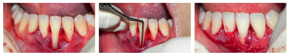 Periodontal Procedure by expert periodontist in Melbourne
