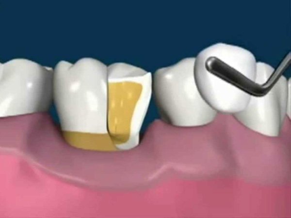 Crown Lengthening
