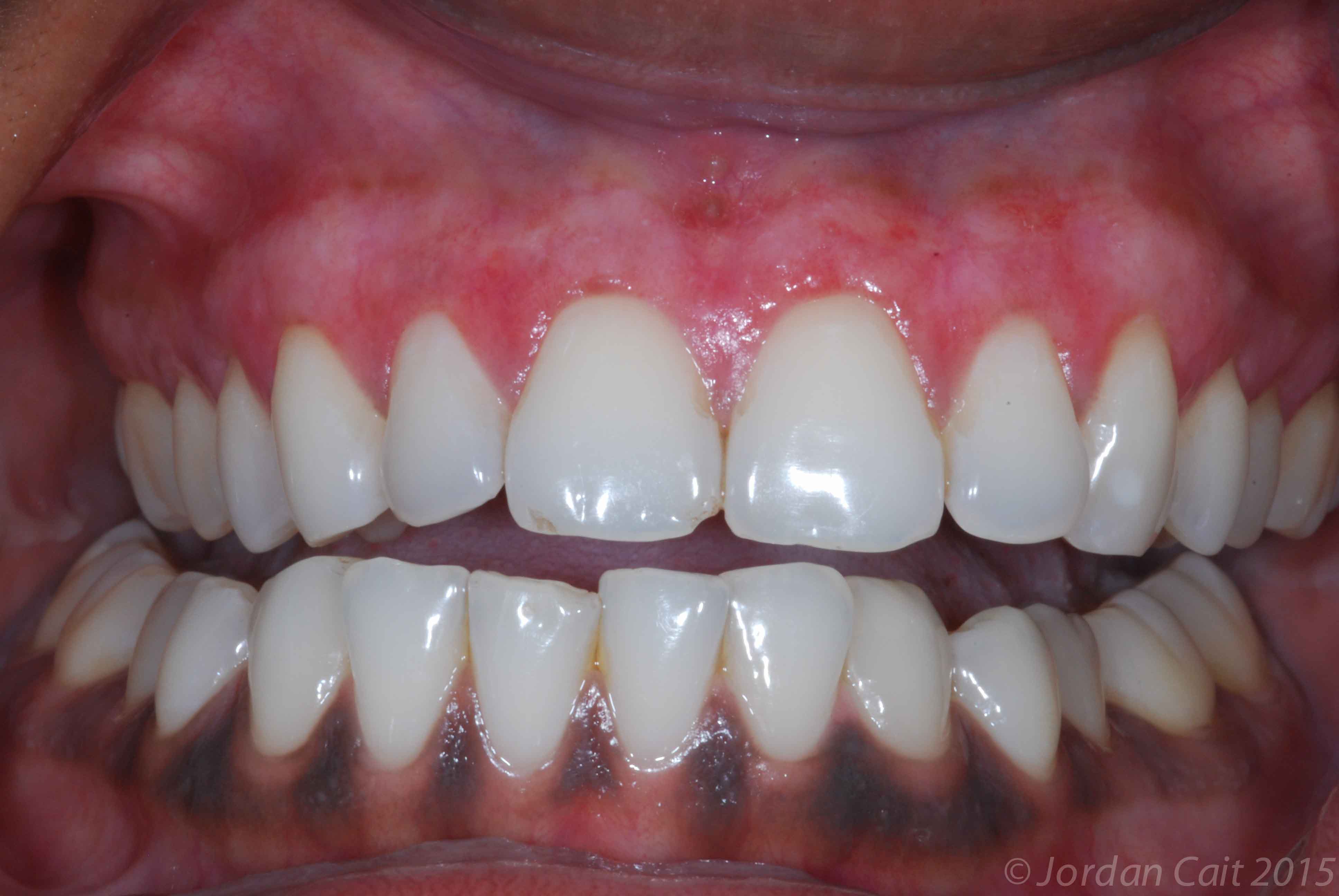 gums bleaching