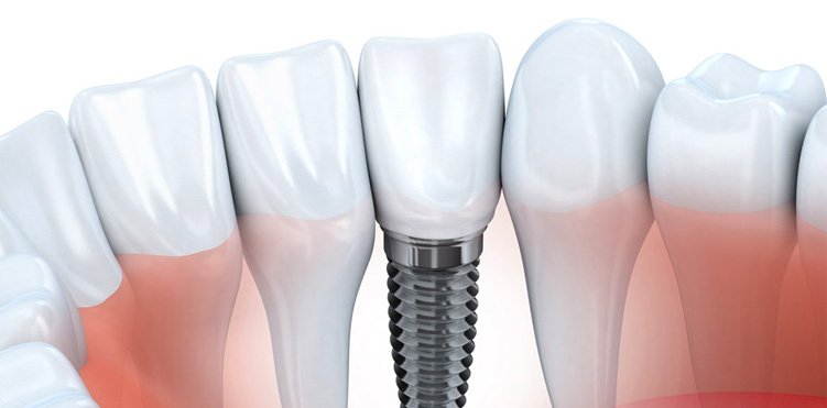 dental implants