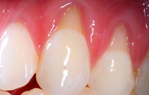Causes and treatment of receding gums