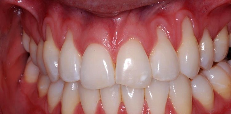 Is Gingival Recession a Lost Cause?