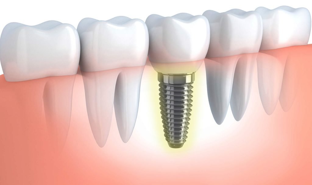 melbourne-periocare-dental-implant-illustration