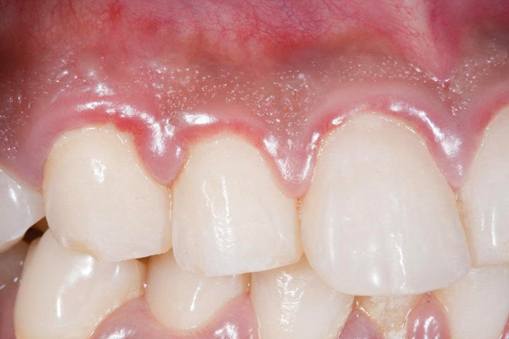 swollen-tender-gums-caused-by-gingivitis